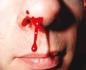 Jak spowodować krew z nosa. Czynniki prowokujące