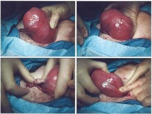 Operacja usunięcia mięśniaków macicy, zeznanie